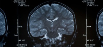 Work of Post-doctoral fellow, Angela Auriat, featured by the Canadian Partnership for Stroke Recovery
